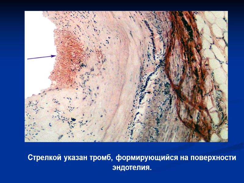 Стрелкой указан тромб, формирующийся на поверхности эндотелия.